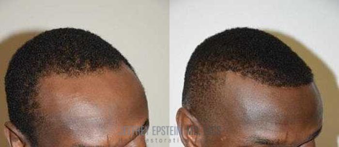 Before & After Hairline Lowering / Forehead Reduction Case 96 View 2 View in Miami, FL