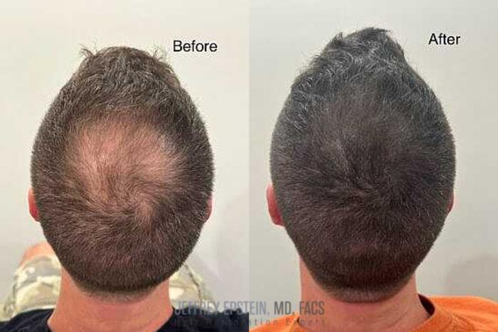 Before & After Scalp Micropigmentation Case 362 View 1 View in Miami, FL