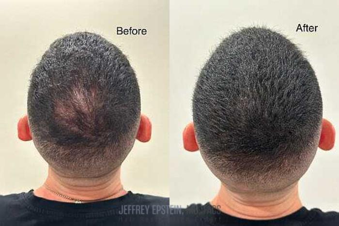 Before & After Scalp Micropigmentation Case 364 View 1 View in Miami, FL