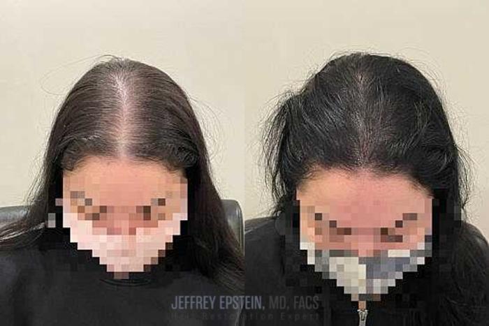 Before & After Scalp Micropigmentation Case 366 View 1 View in Miami, FL