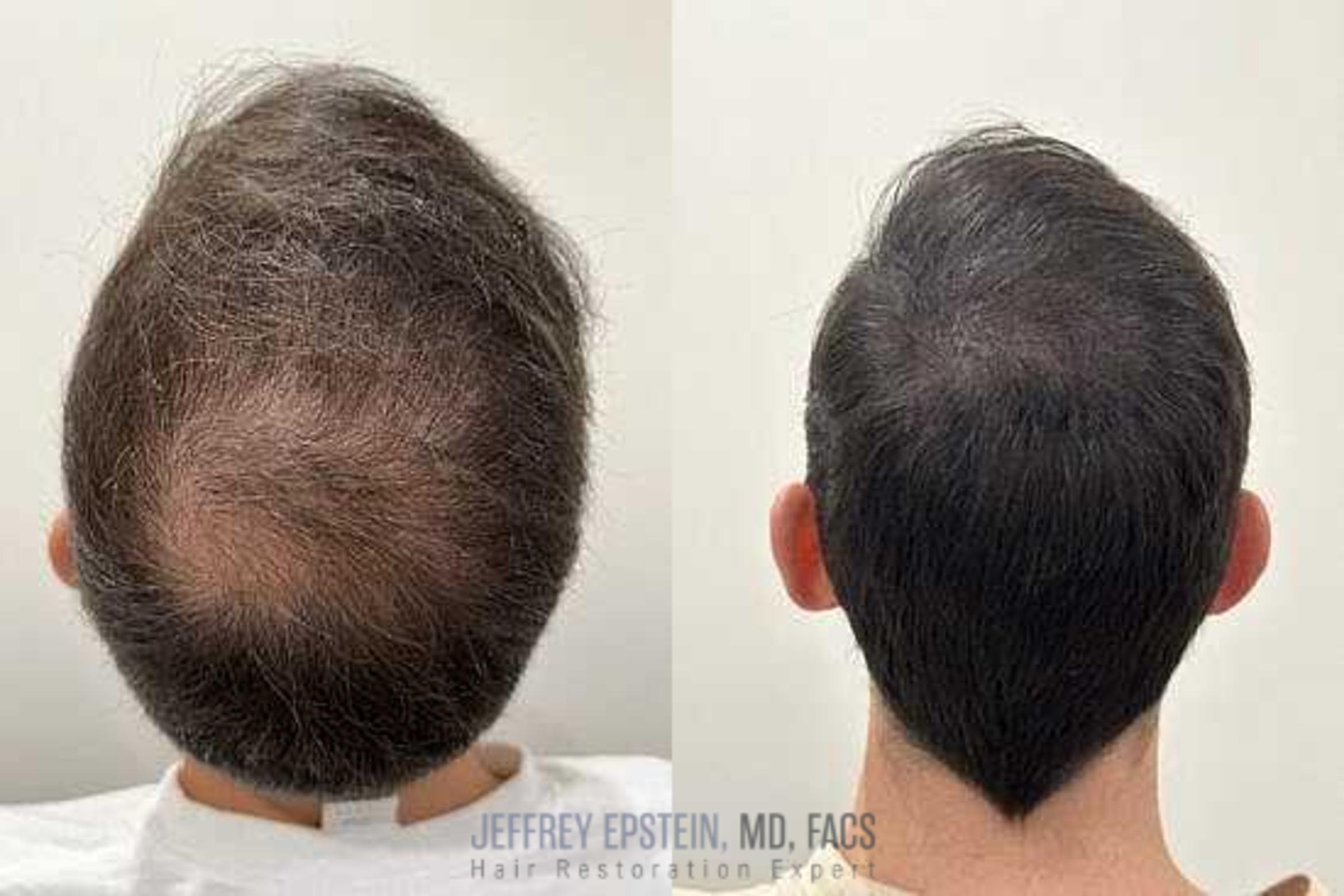 Before & After Scalp Micropigmentation Case 367 View 1 View in Miami, FL