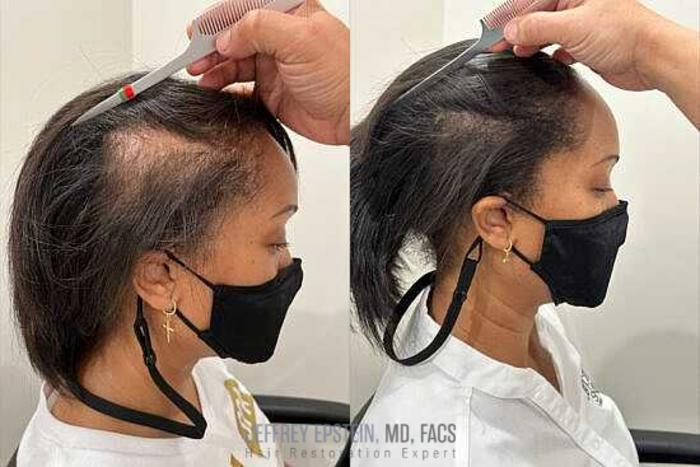 Before & After Scalp Micropigmentation Case 370 View 1 View in Miami, FL
