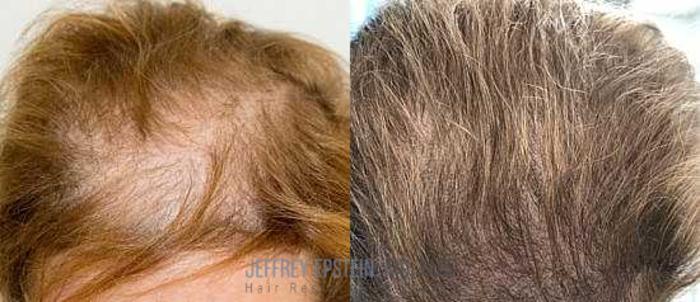 Before & After Scalp Micropigmentation Case 371 View 1 View in Miami, FL