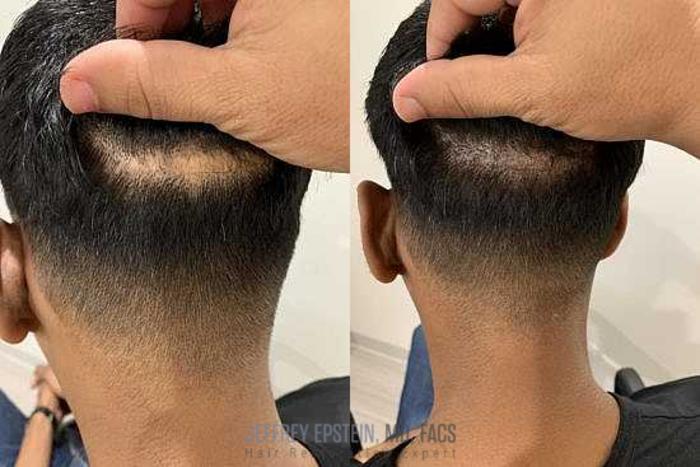 Before & After Scalp Micropigmentation Case 372 View 1 View in Miami, FL