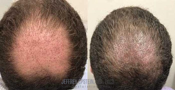 Before & After Scalp Micropigmentation Case 373 View 1 View in Miami, FL