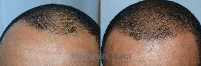 Before & After Scalp Micropigmentation Case 374 View 2 View in Miami, FL