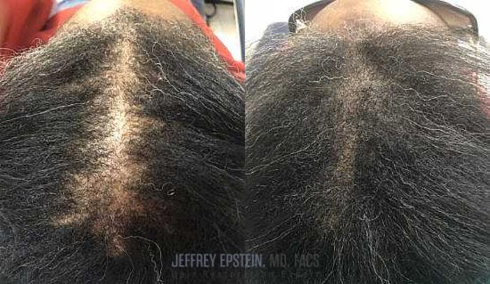 Before & After Scalp Micropigmentation Case 376 View 1 View in Miami, FL