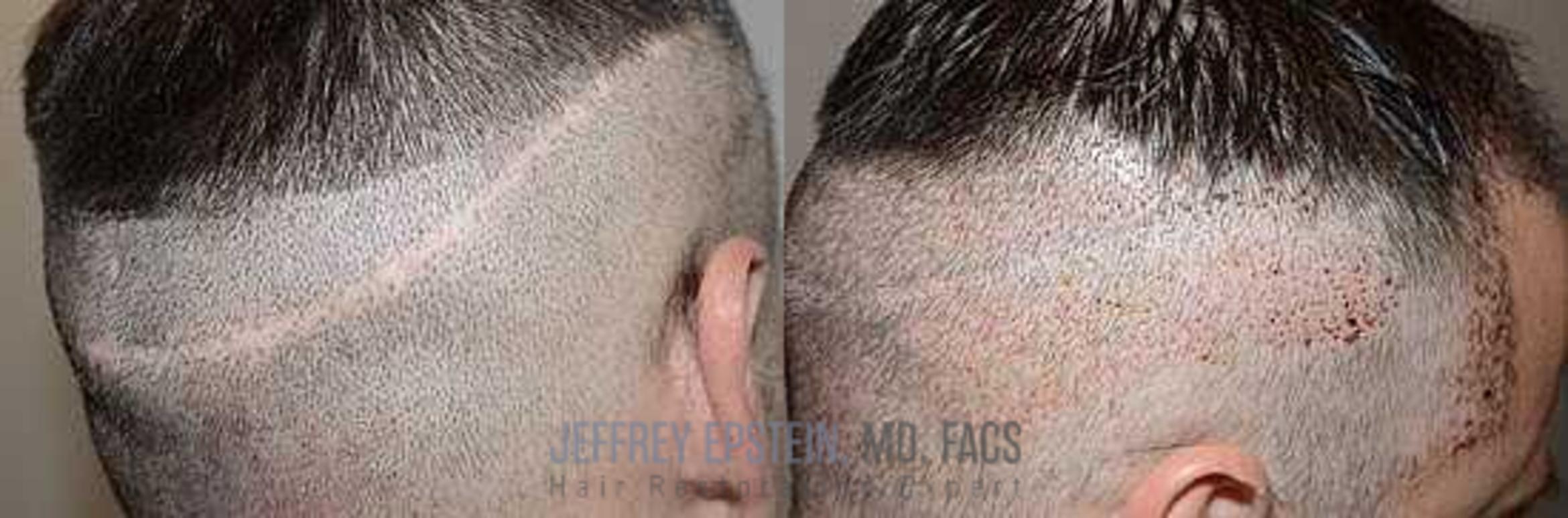 Before & After Scalp Micropigmentation Case 377 View 1 View in Miami, FL