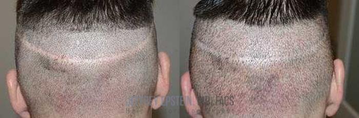 Before & After Scalp Micropigmentation Case 377 View 2 View in Miami, FL