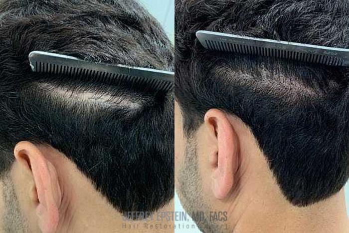 Before & After Scalp Micropigmentation Case 380 View 1 View in Miami, FL