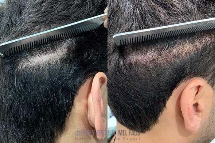 Before & After Scalp Micropigmentation Case 380 View 2 View in Miami, FL