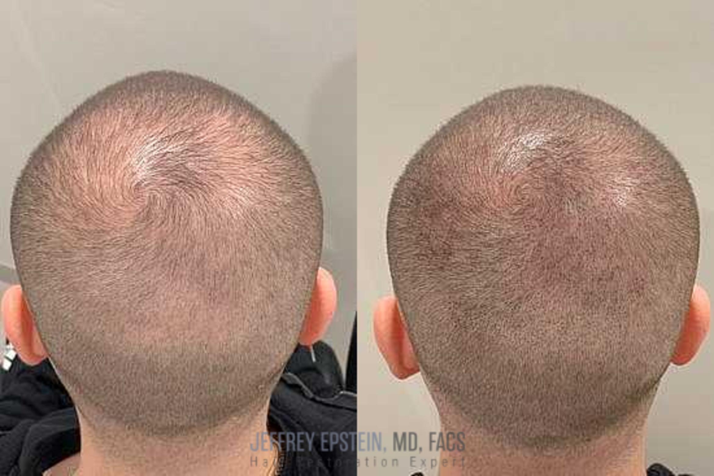 Before & After Scalp Micropigmentation Case 381 View 1 View in Miami, FL