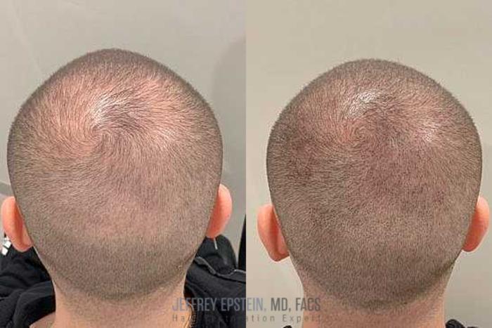 Before & After Scalp Micropigmentation Case 381 View 1 View in Miami, FL