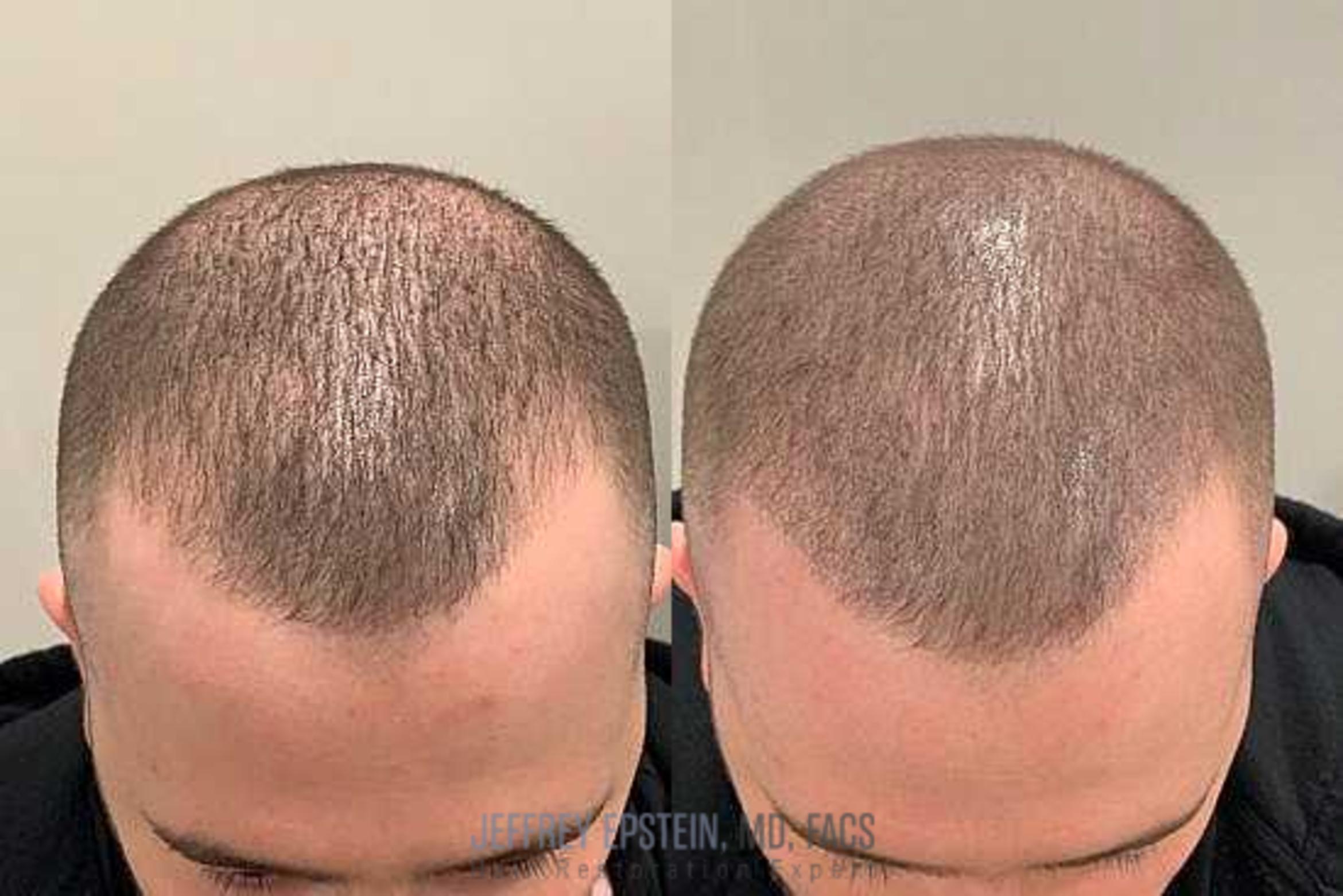 Before & After Scalp Micropigmentation Case 381 View 2 View in Miami, FL